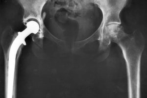 5 Things to Know About Joint Replacement Surgery