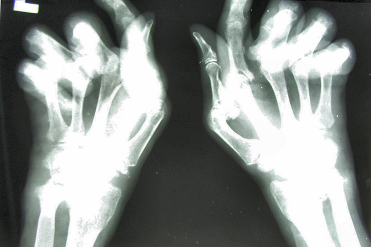 Pain in the Joints: Should You Worry?
