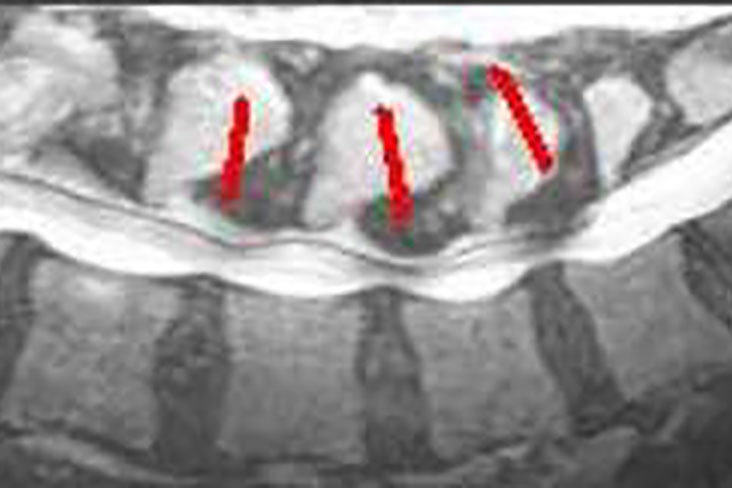 Symptoms and Pain Management of Spinal Stenosis