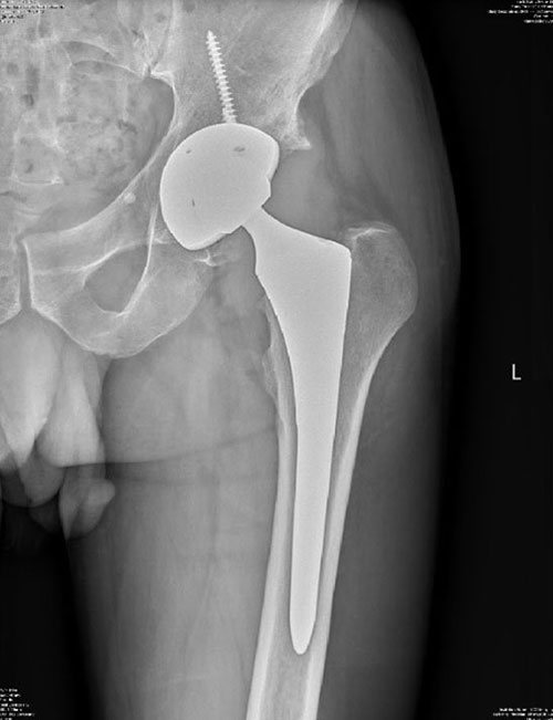 Bjios After Hip Replacement