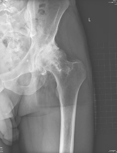 Bjios Before Hip Replacement