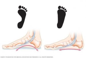 Flat Foot Surgery